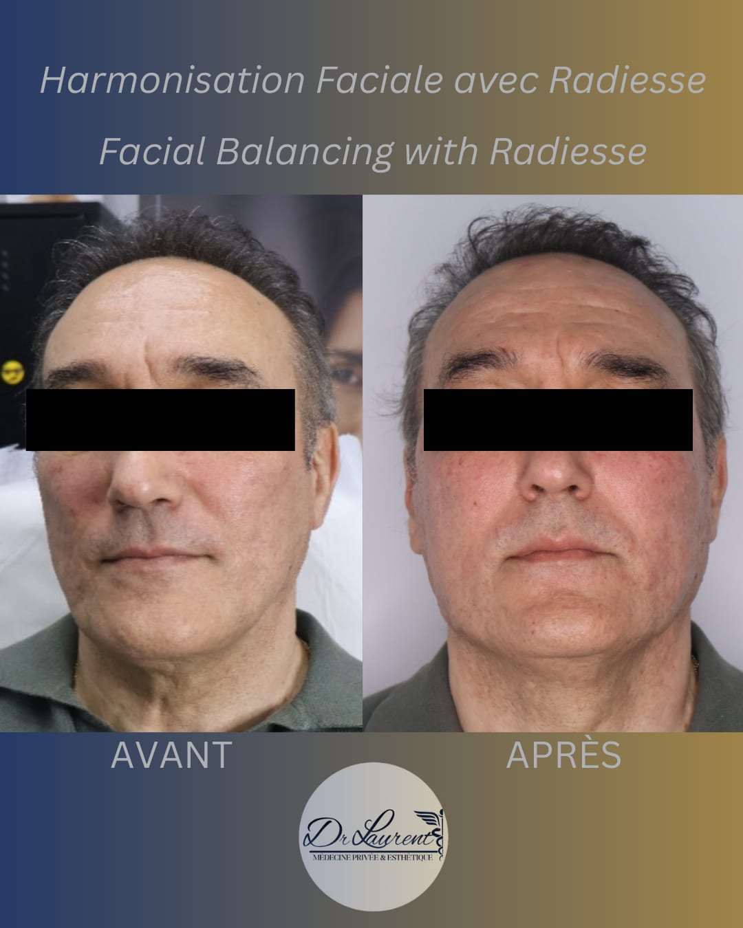 Bio-stimulators (Radiesse) — 2