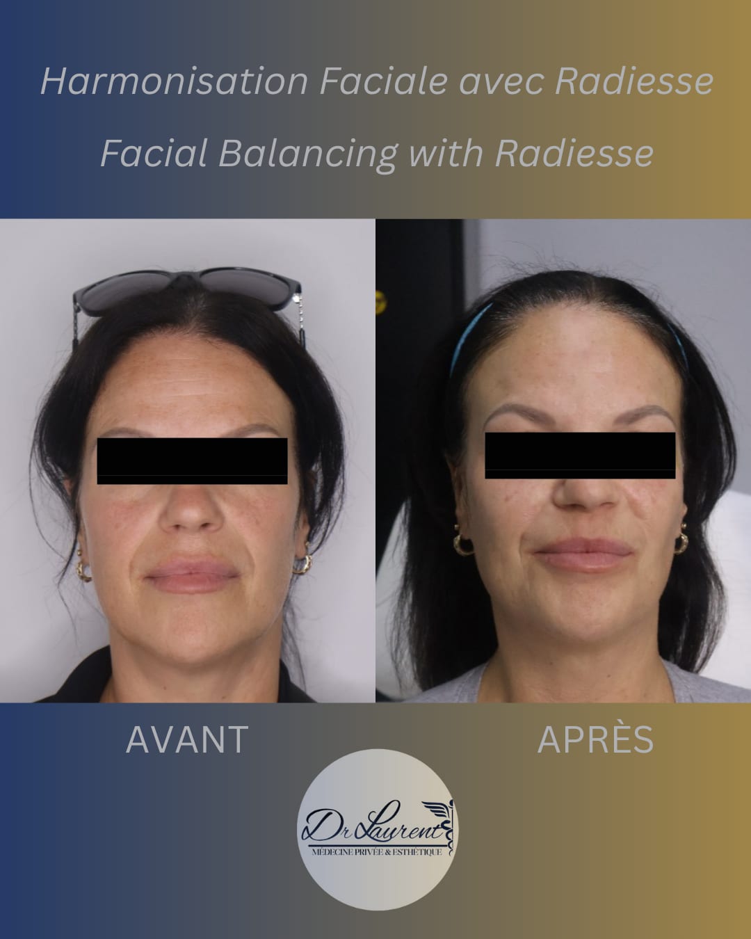 Bio-stimulators (Radiesse) — 3