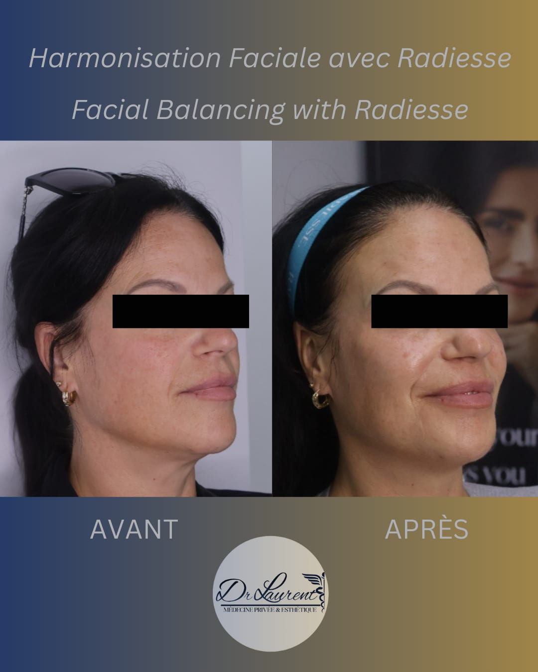 Bio-stimulators (Radiesse) — 4
