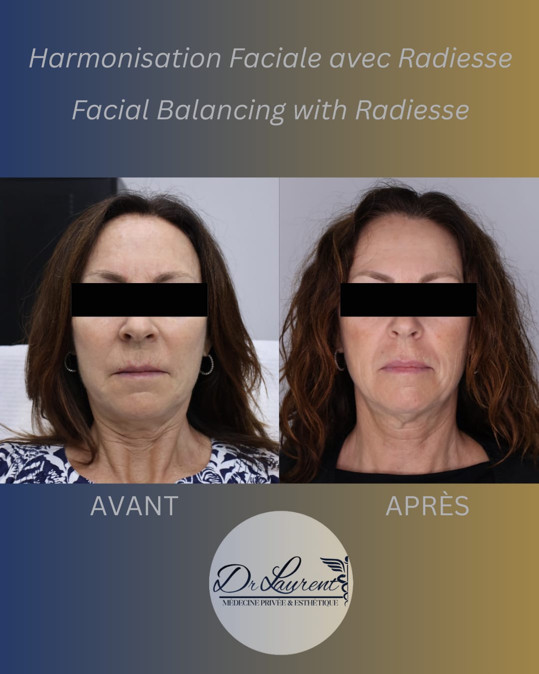 Bio-stimulators (Radiesse) — 5