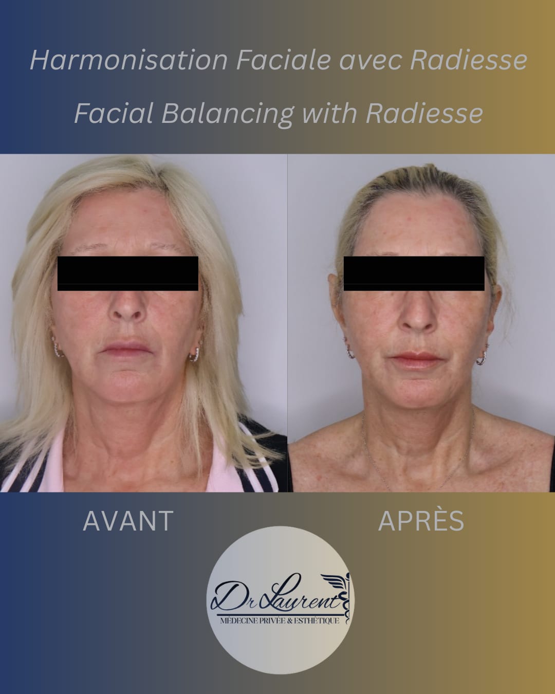 Bio-stimulators (Radiesse) — 6