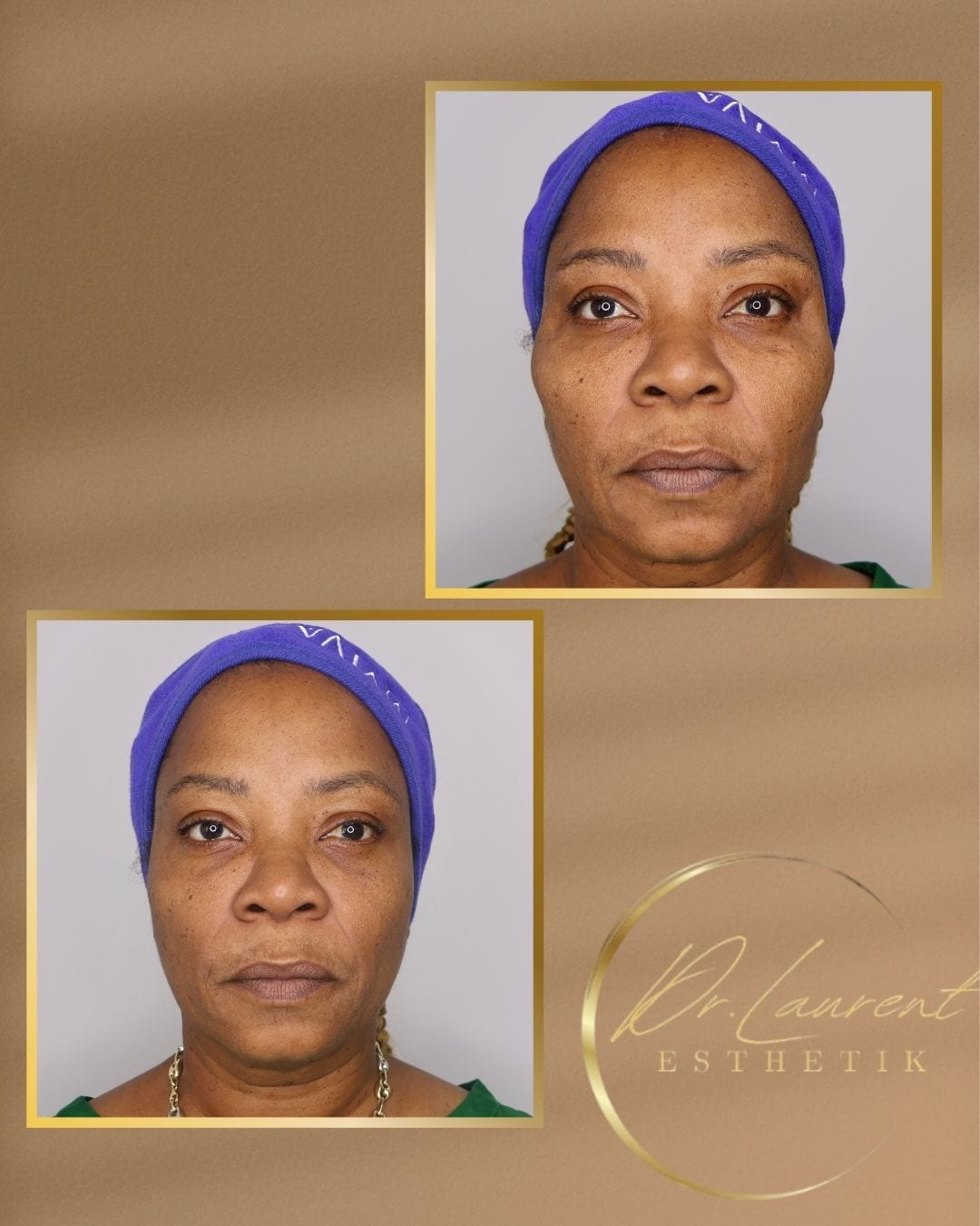 Bio-stimulators (Radiesse) — 7