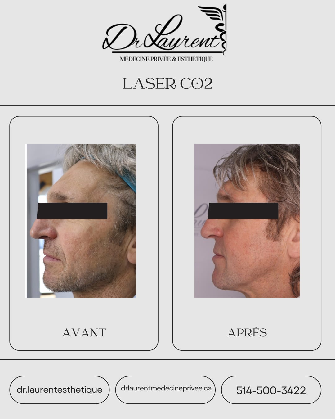 Fractional CO2 Laser — 10