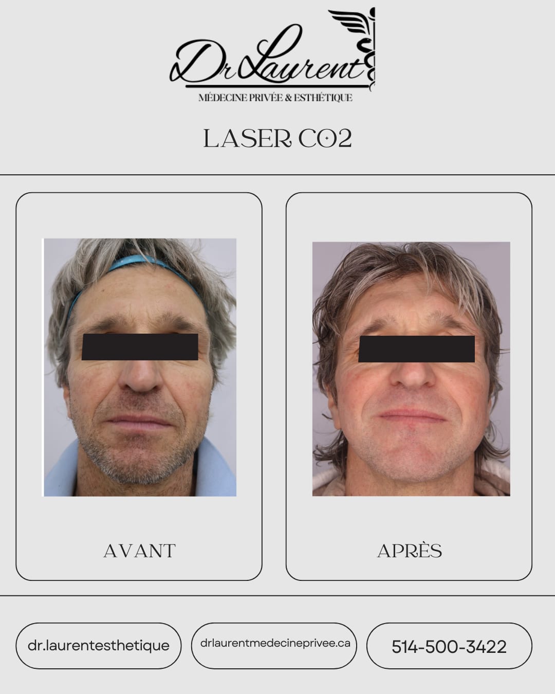 Fractional CO2 Laser — 11
