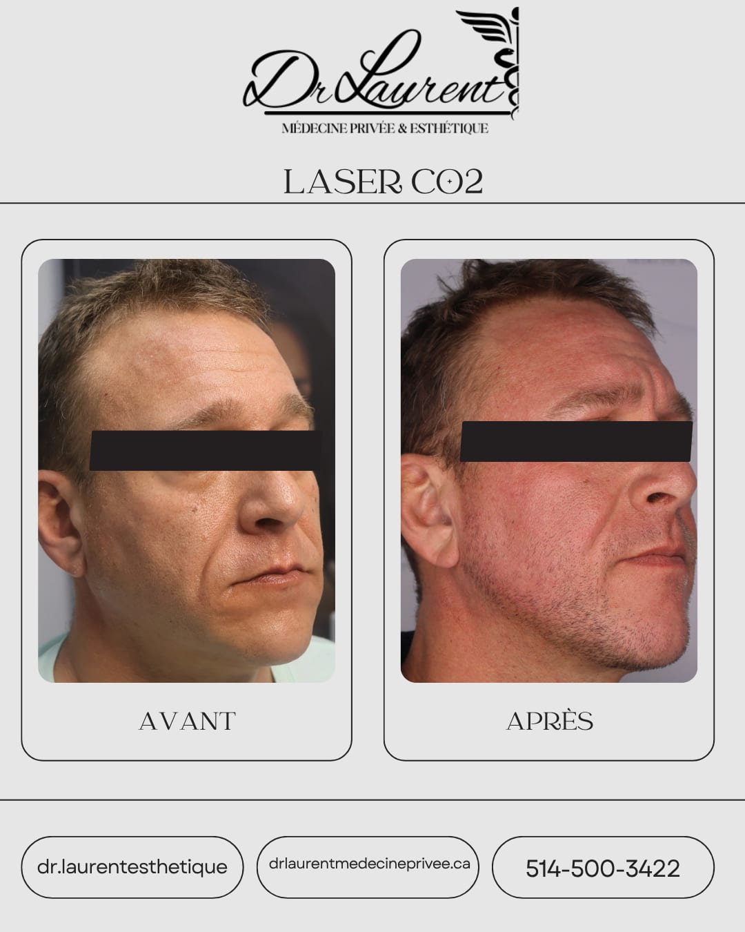 Fractional CO2 Laser — 12