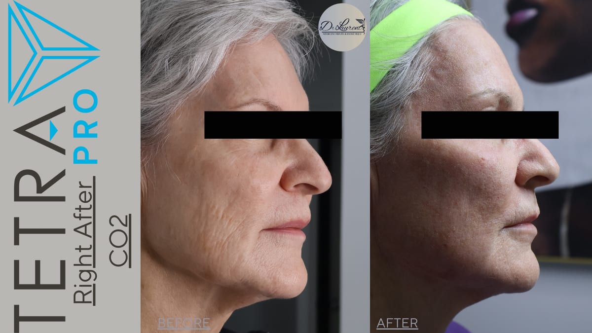 Fractional CO2 Laser — 5