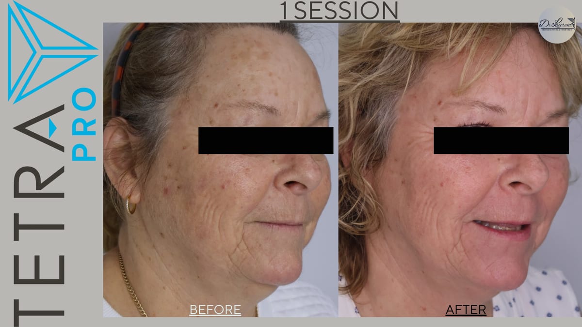 Fractional CO2 Laser — 6