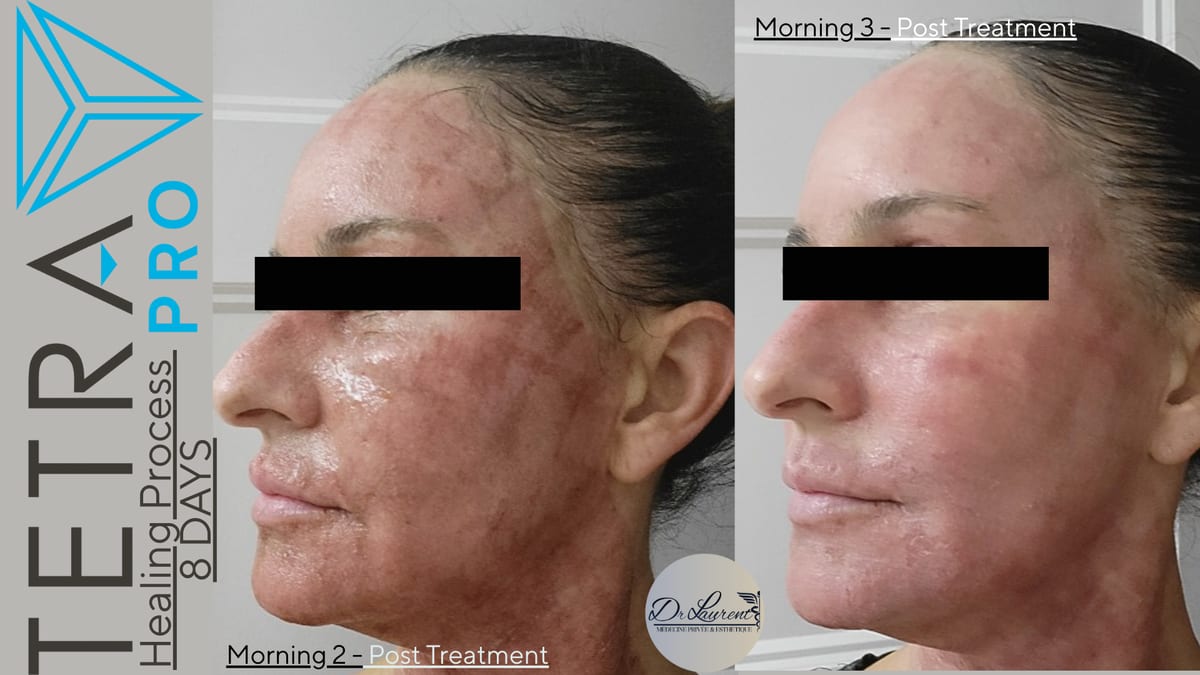 Fractional CO2 Laser — 8
