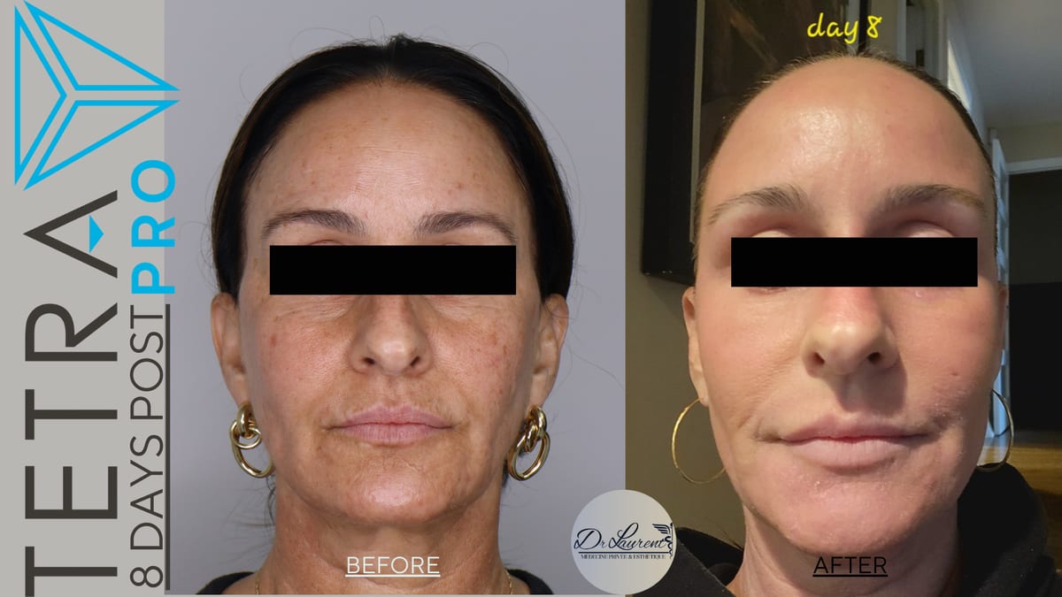Fractional CO2 Laser — 9