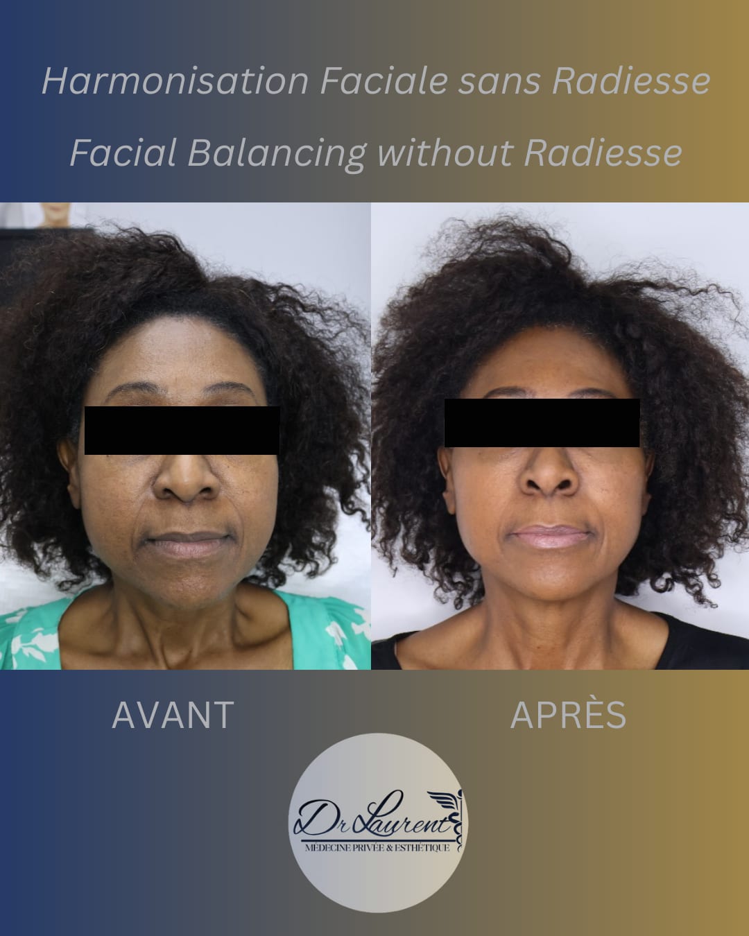 Facial Balancing (HA) — 2