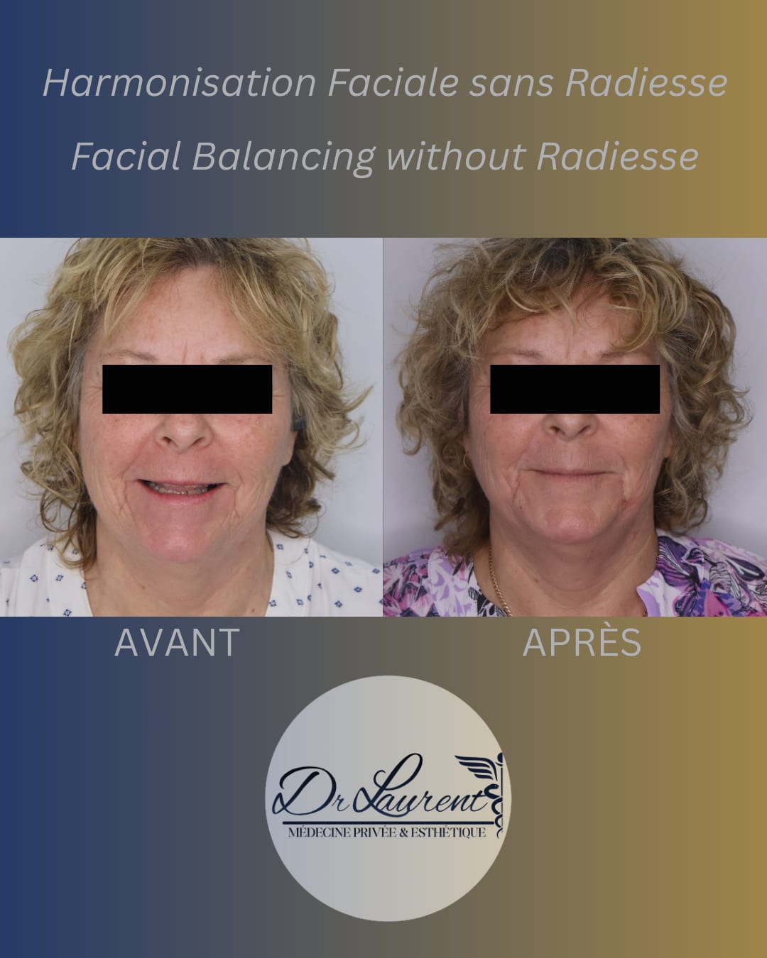 Facial Balancing (HA) — 3