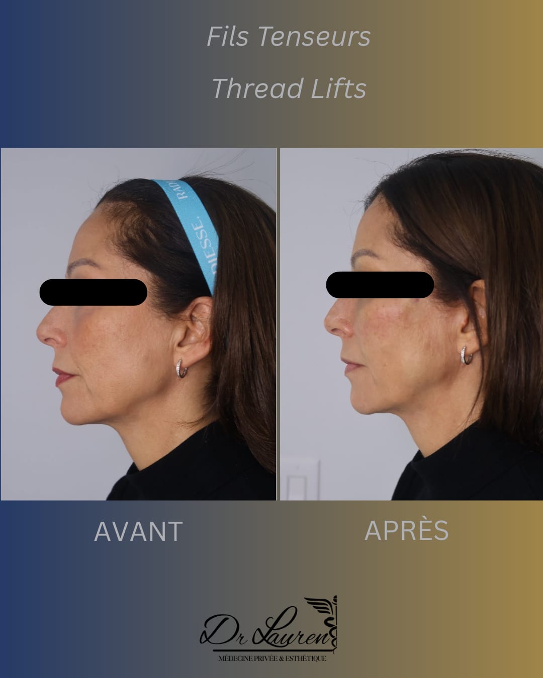 APTOS Thread Lift — 2