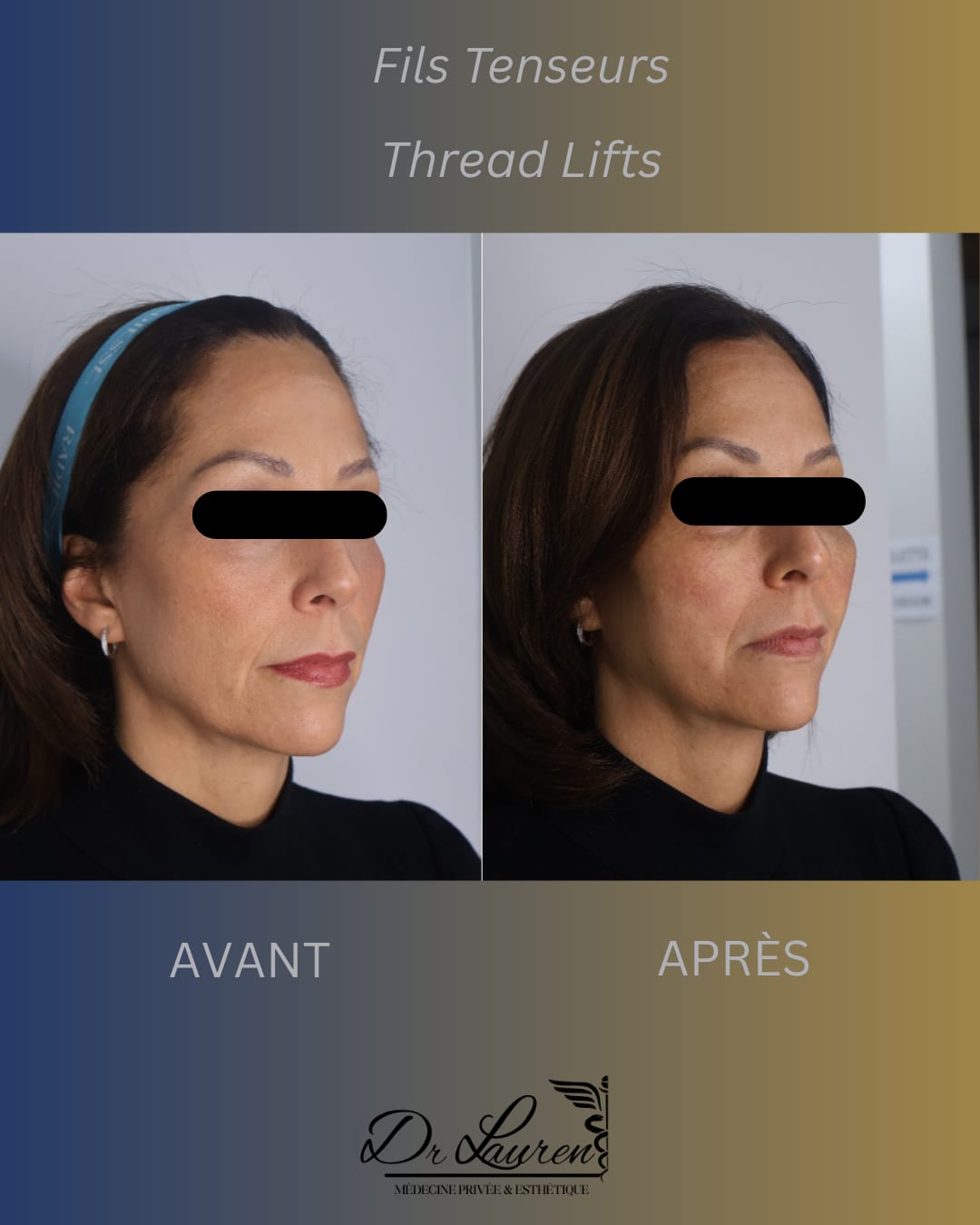 APTOS Thread Lift — 3