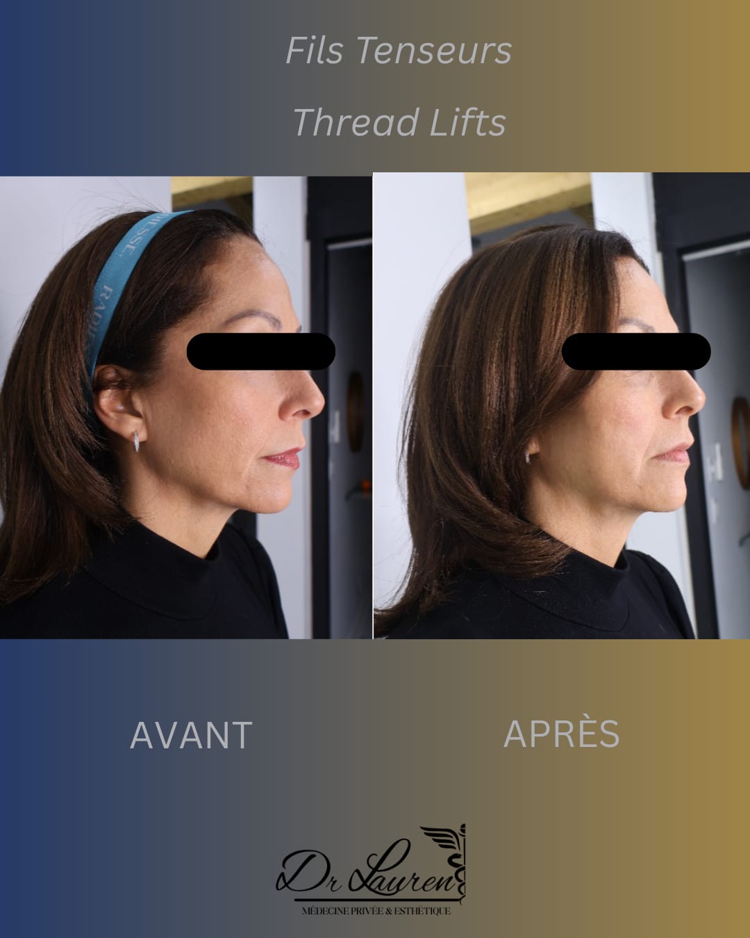 APTOS Thread Lift — 4