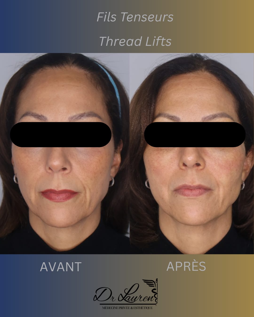 APTOS Thread Lift — 5