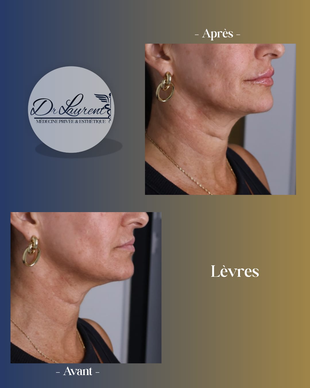 Lip Filler — 2