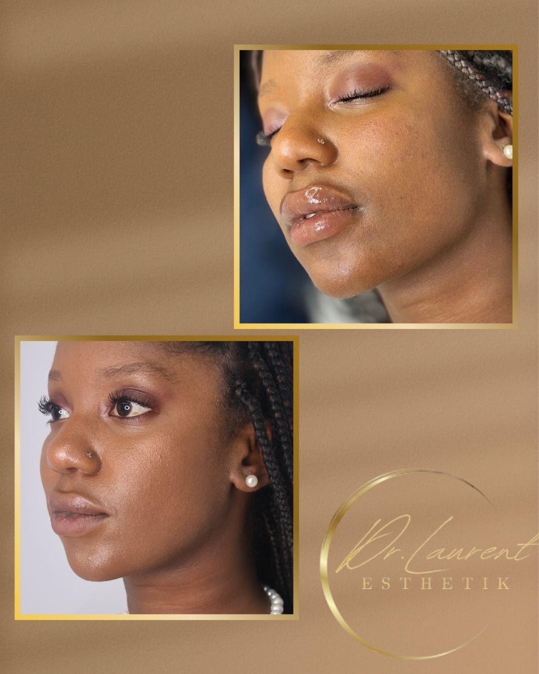 Lip Filler — 3