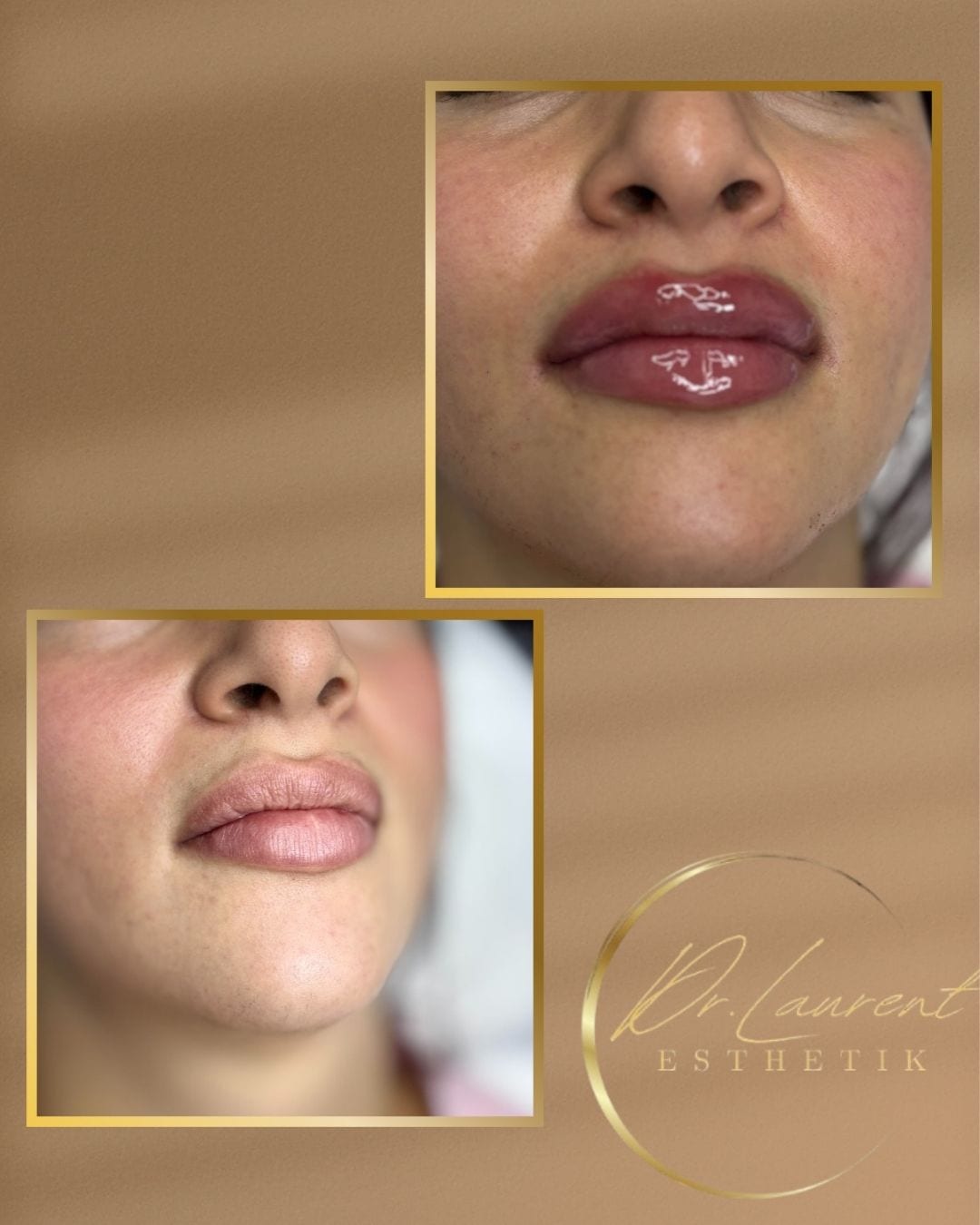 Lip Filler — 5