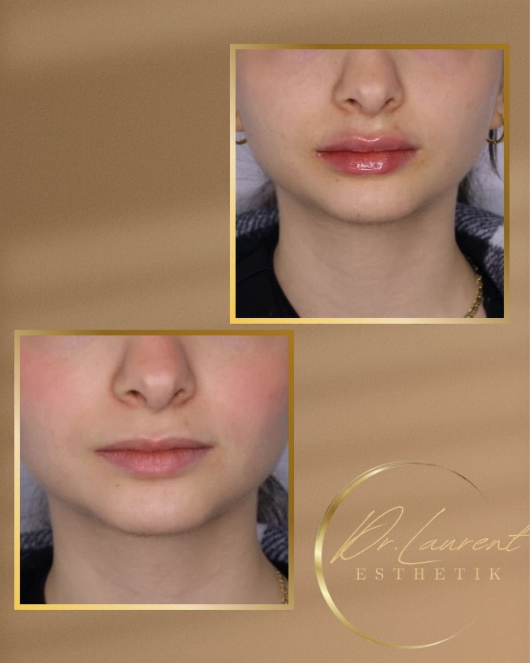 Lip Filler — 6