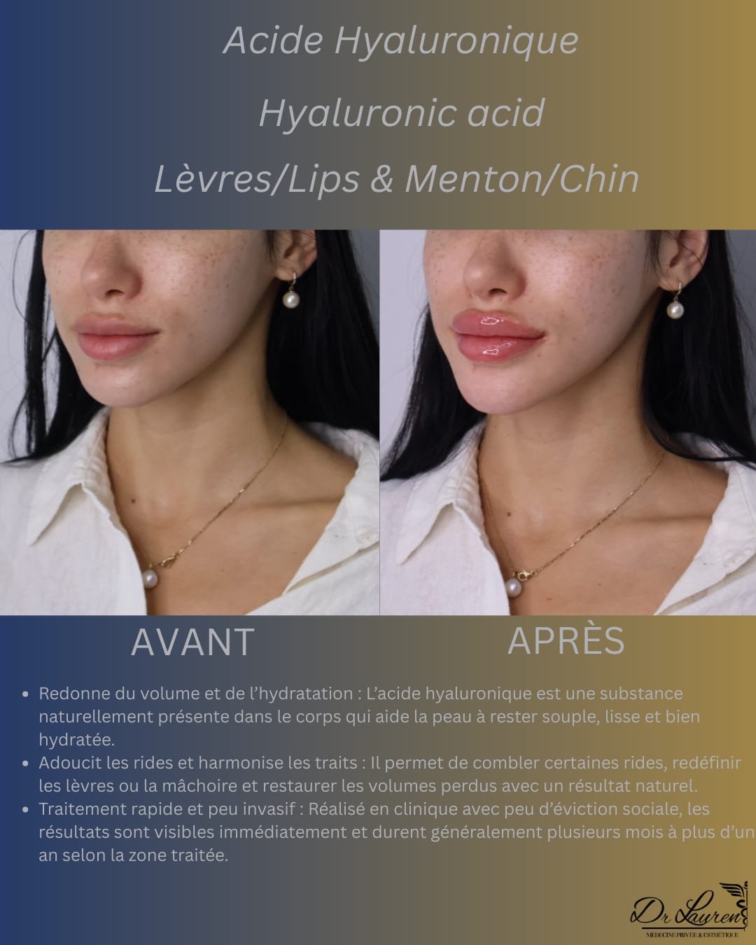 Lip Filler — 7