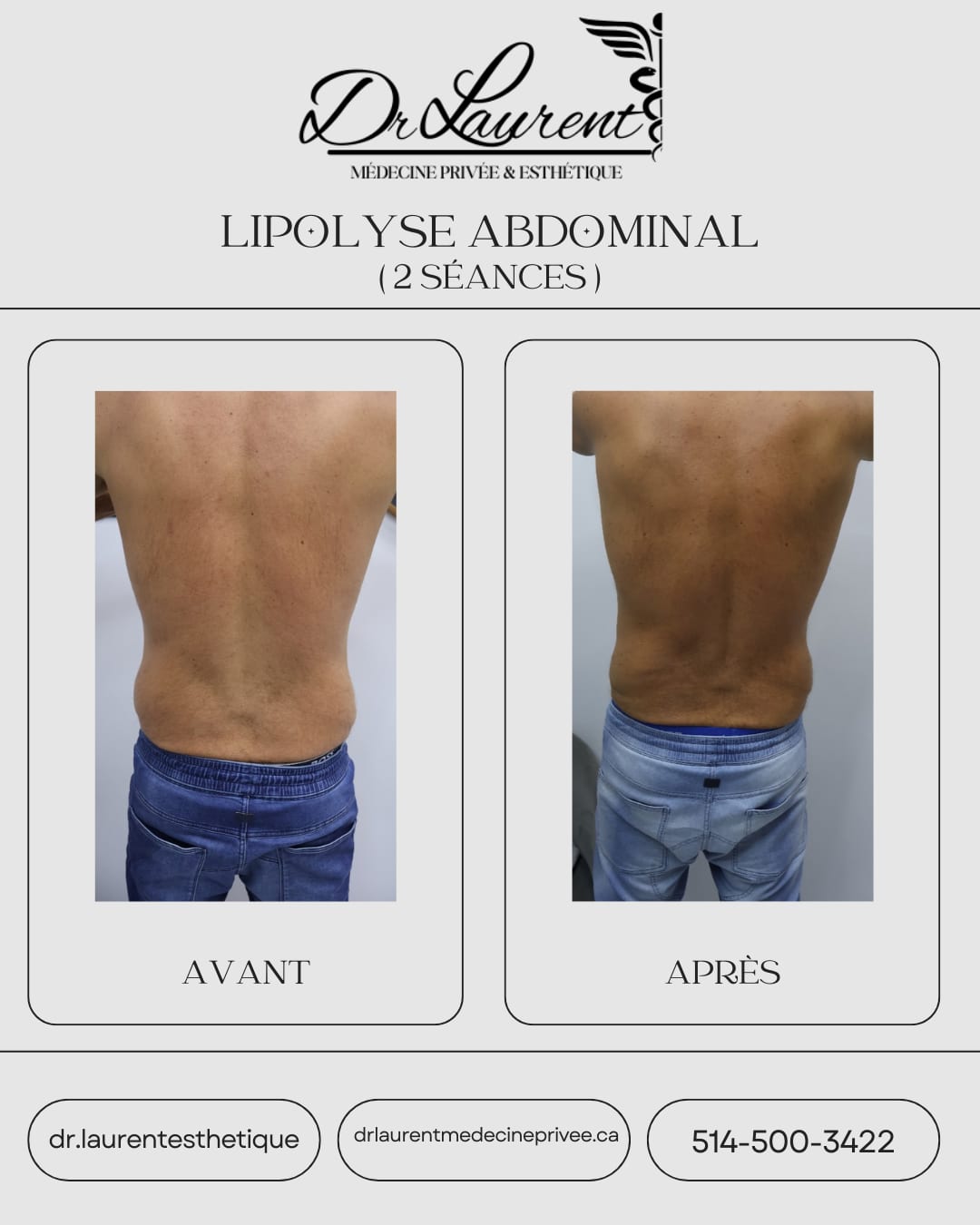 Lipolysis — 3
