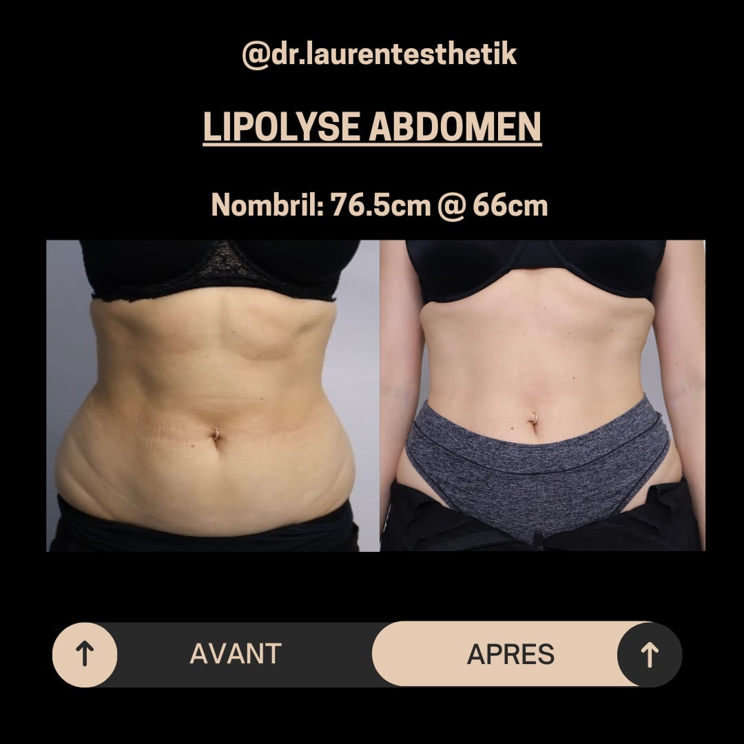 Lipolysis — 5
