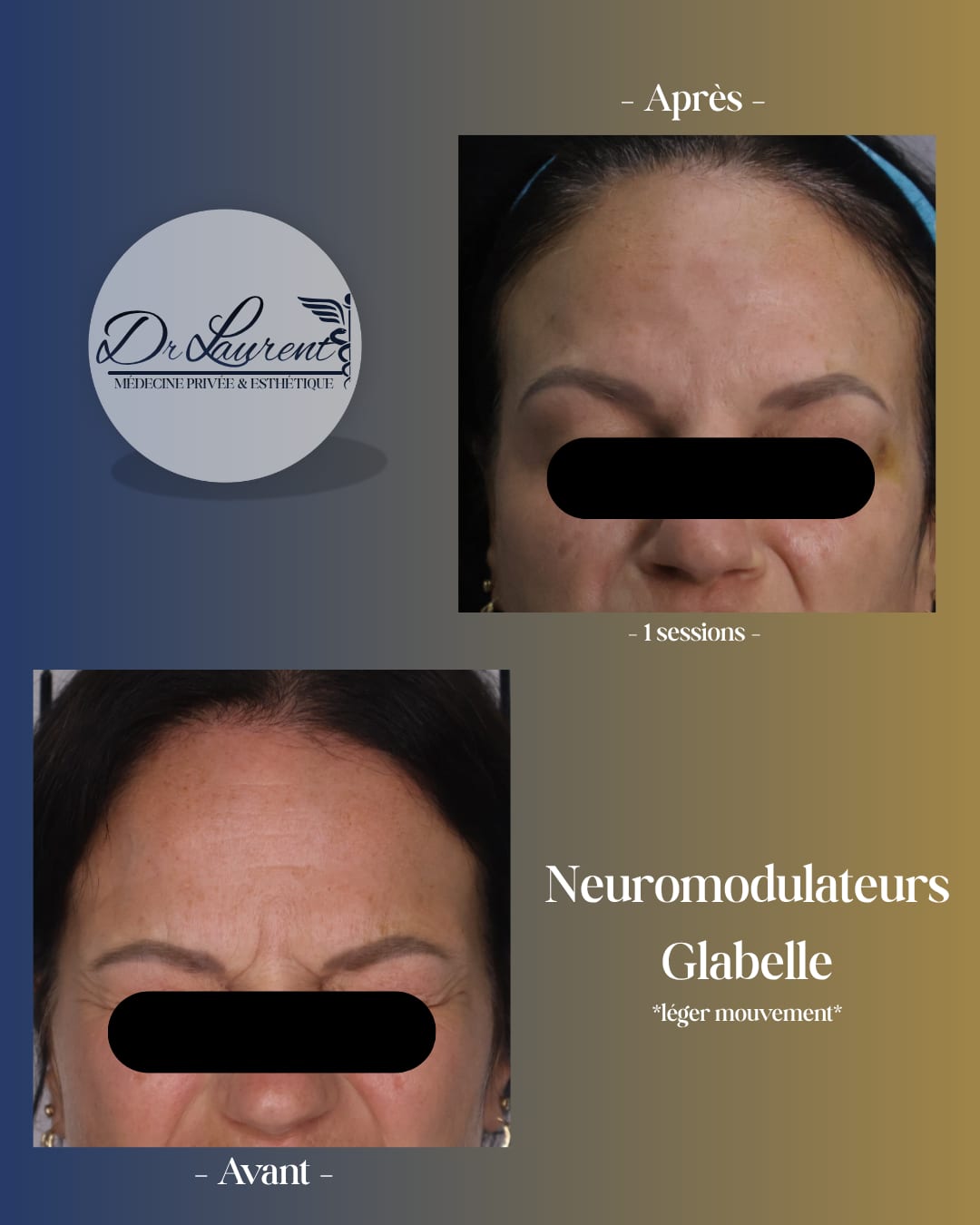 Neuromodulators (Botox) — 2
