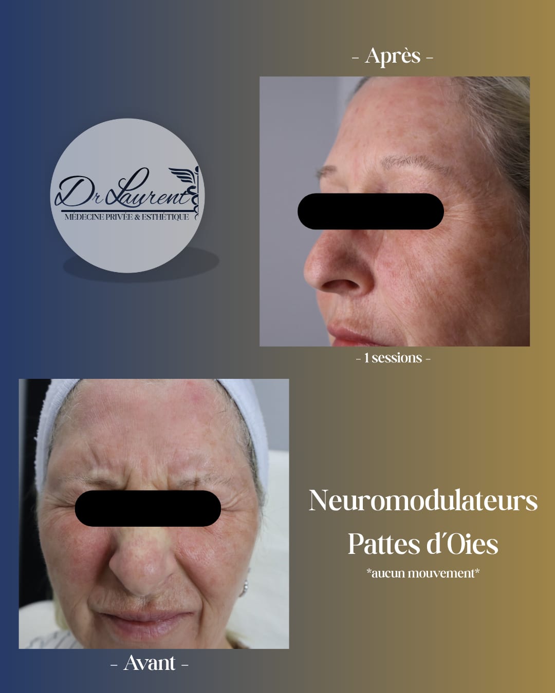 Neuromodulators (Botox) — 3