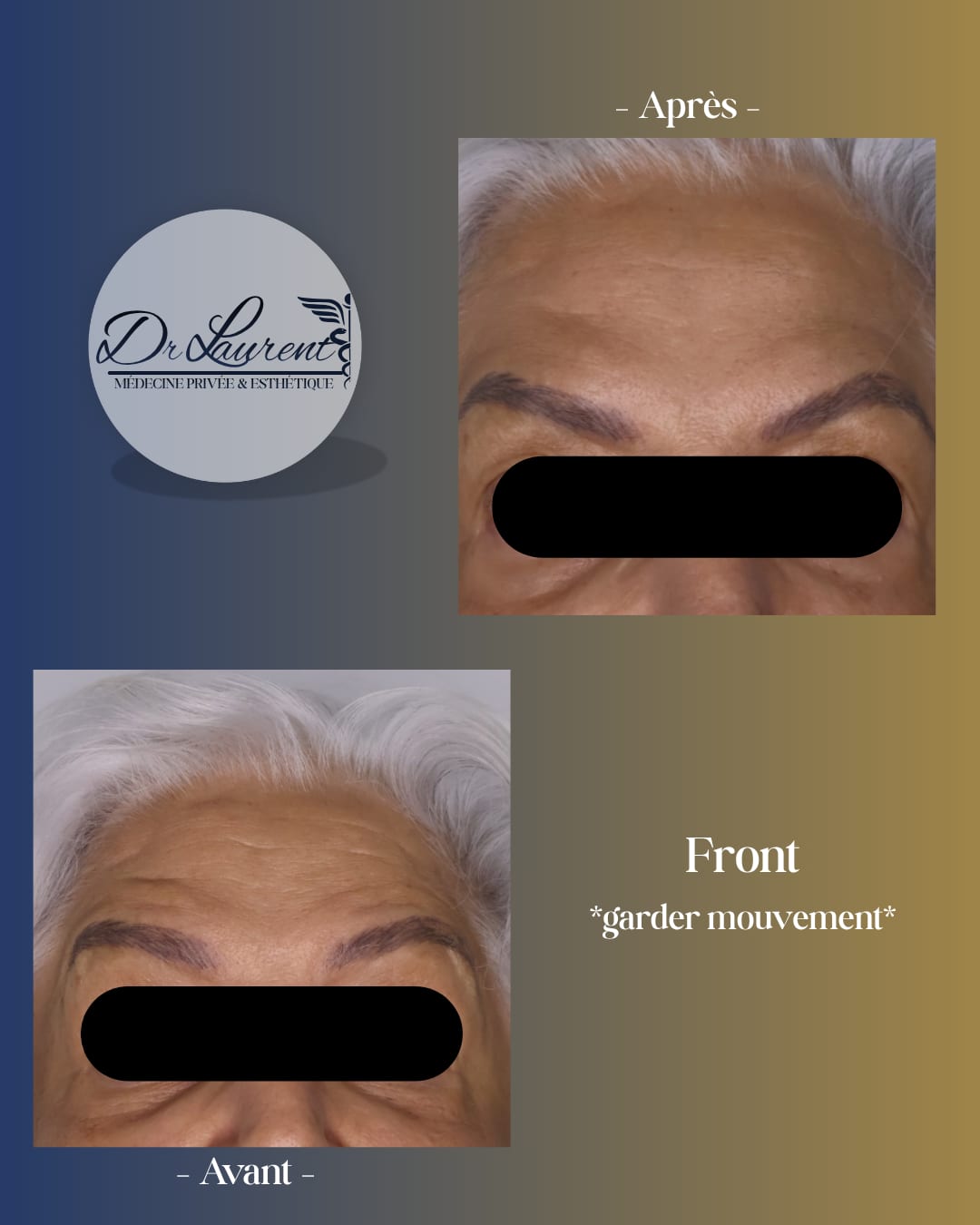 Neuromodulators (Botox) — 4