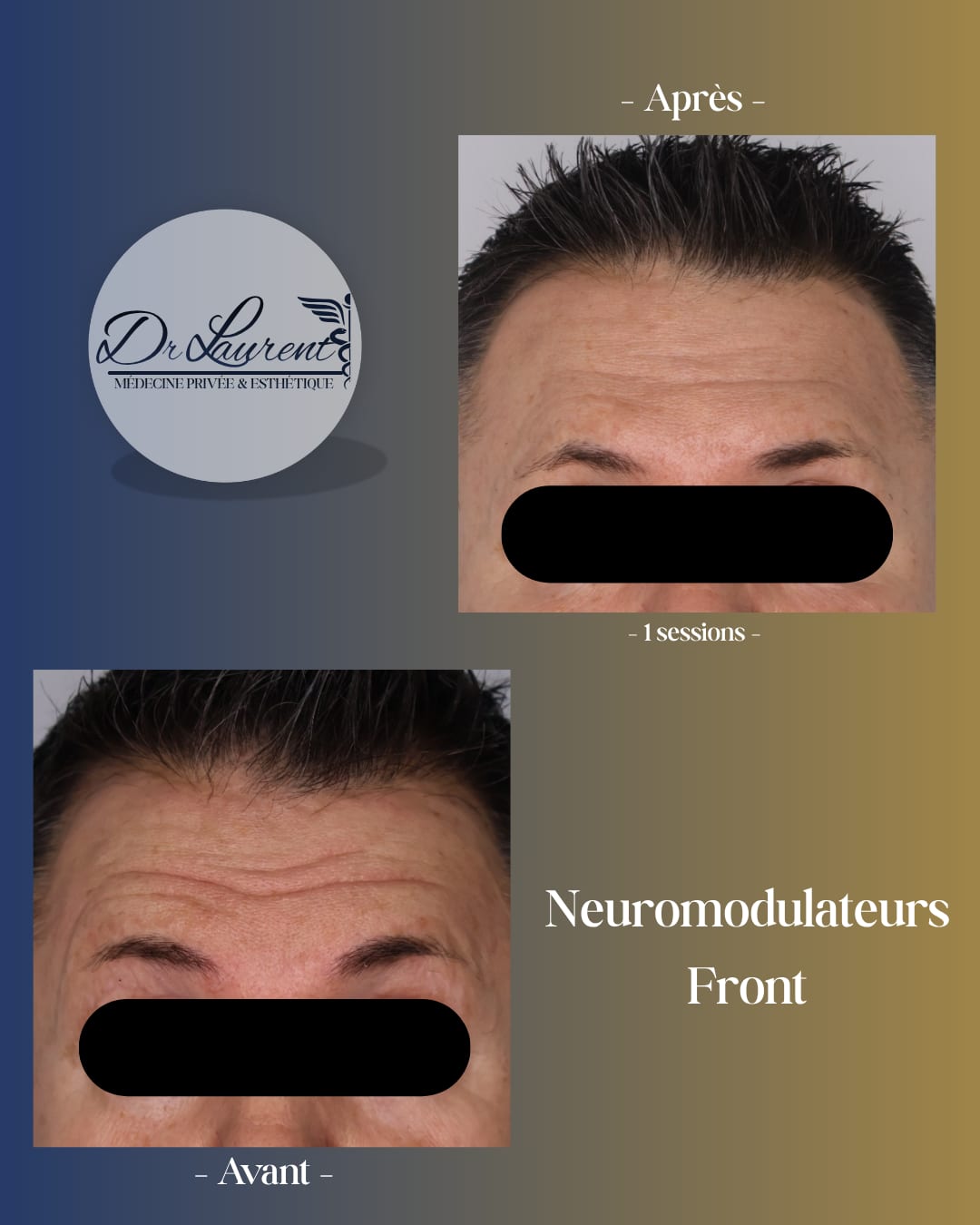 Neuromodulators (Botox) — 6