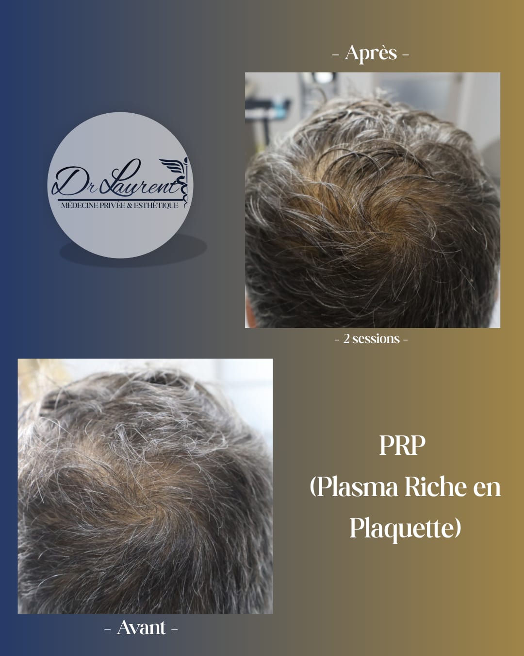 PRP — Platelet-Rich Plasma — 2