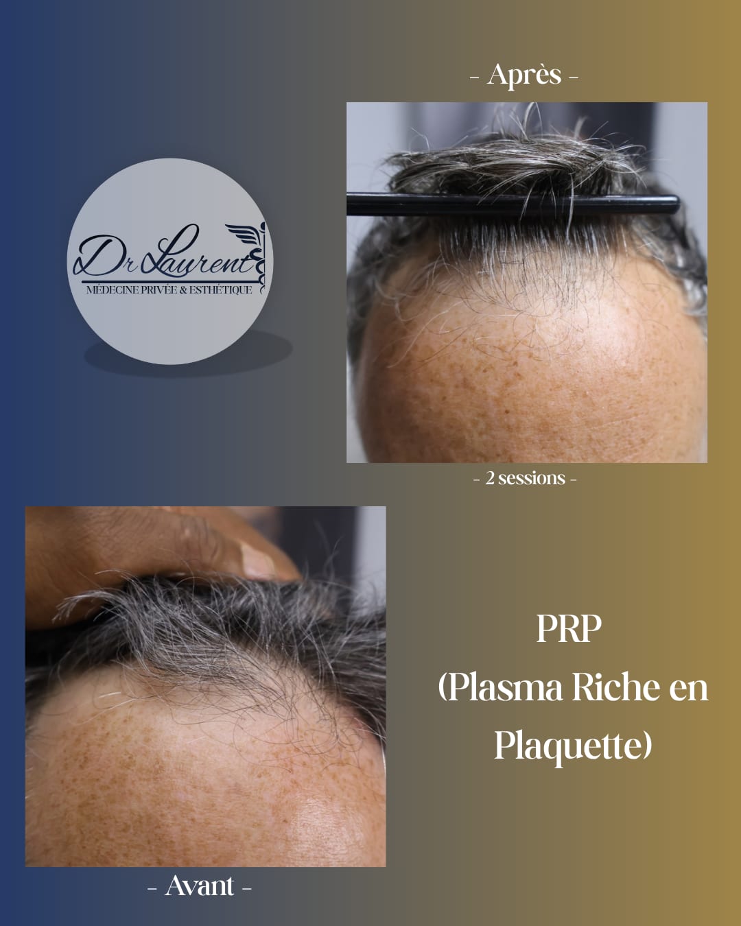 PRP — Platelet-Rich Plasma — 3