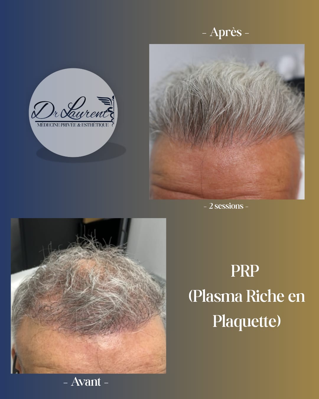 PRP — Platelet-Rich Plasma — 4