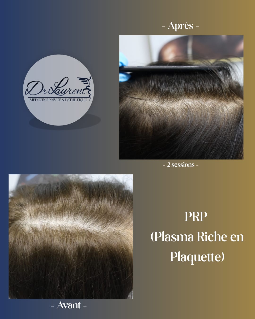 PRP — Platelet-Rich Plasma — 5